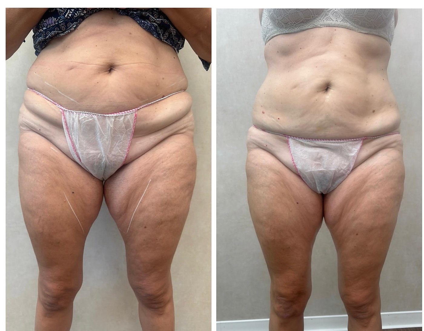 Body Reset — adiposità diffusa e lassità — Prima e dopo