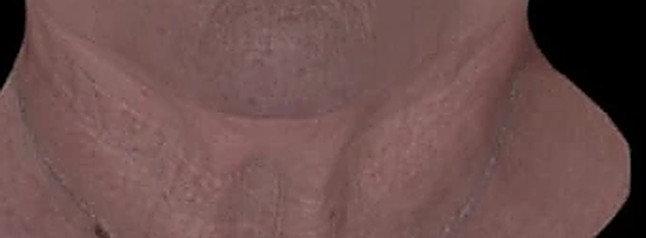 Fotoinvecchiamento, lassità e qualità cutanea — Collo dopo