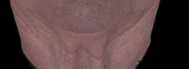Fotoinvecchiamento, lassità e qualità cutanea — Collo prima