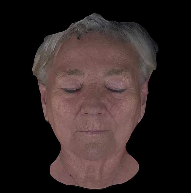 Fotoinvecchiamento, lassità e qualità cutanea — dopo
