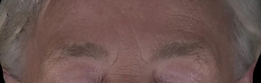 Fotoinvecchiamento, lassità e qualità cutanea — Fronte dopo