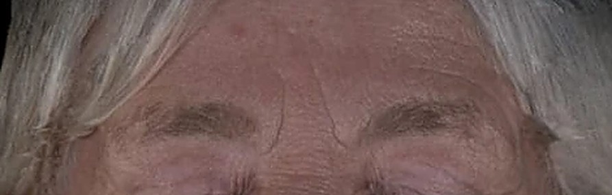 Fotoinvecchiamento, lassità e qualità cutanea — Fronte prima