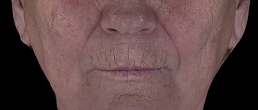 Fotoinvecchiamento, lassità e qualità cutanea — Guance e contorno bocca prima