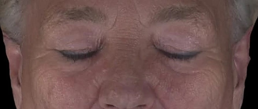 Fotoinvecchiamento, lassità e qualità cutanea — Occhi e sguardo dopo