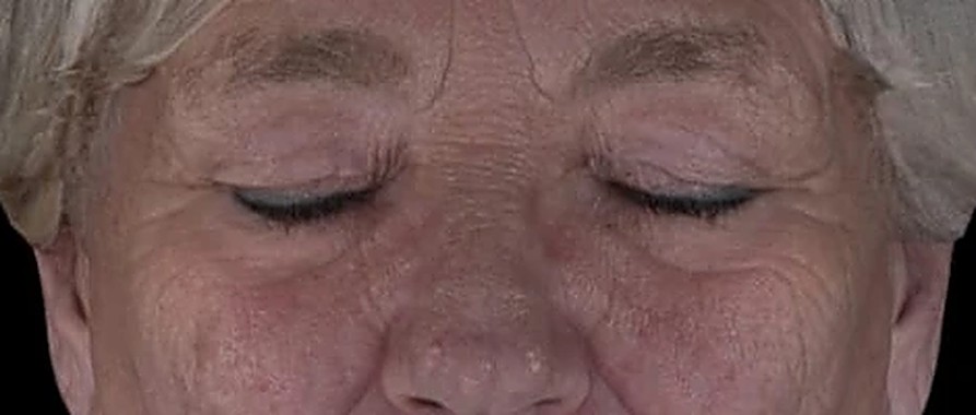 Fotoinvecchiamento, lassità e qualità cutanea — Occhi e sguardo prima